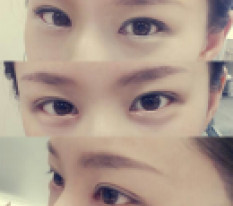 Pretty double-eyelid lines appeared on my plain eyes