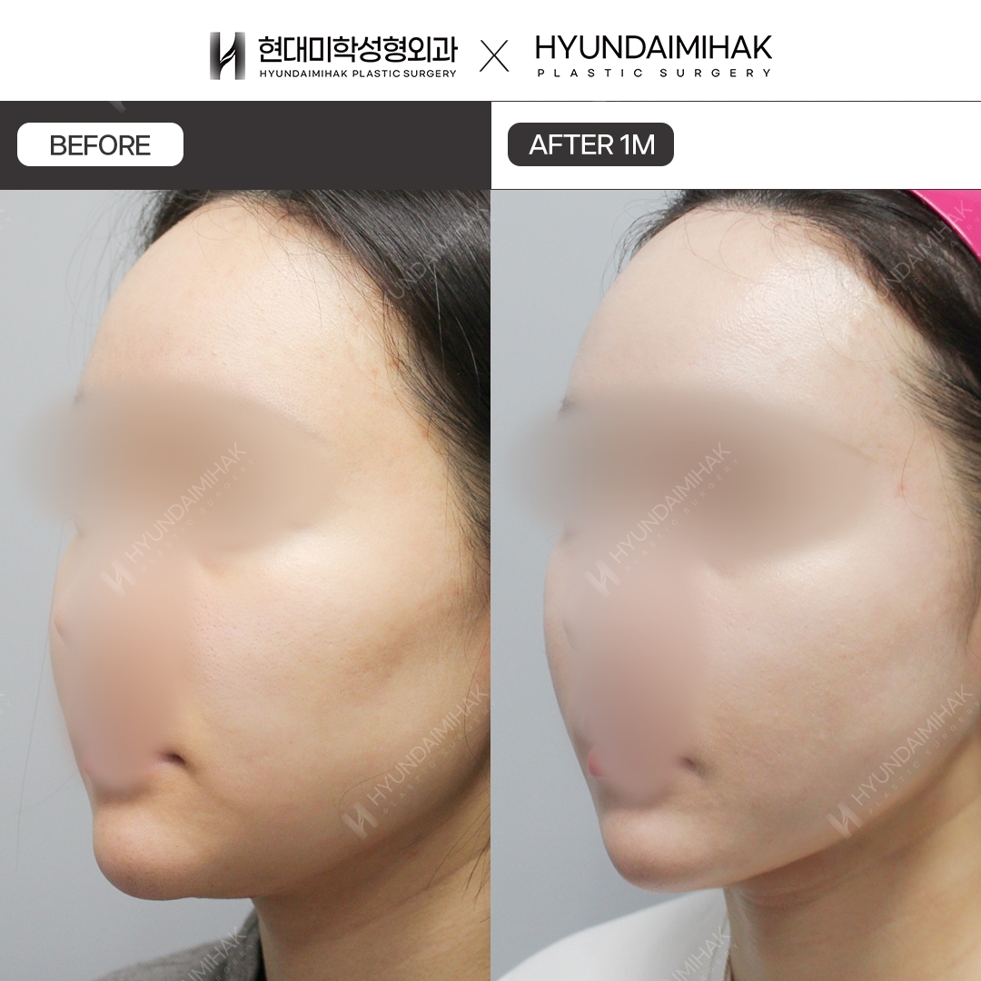 [Lifting] Double-chin thread lift, 1 month
