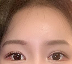 3-month forehead lift