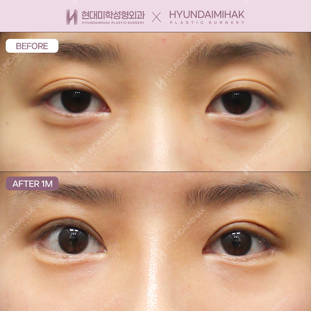 [Revision Eye Surgery] Incisional Double-Eyelid Revision + Dual Canthoplasty