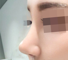 Seeing my pretty new nose makes me feel like a total success ㅋ