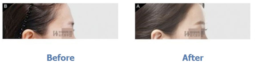 Anti-Aging Surgery + Forehead Fat Grafting