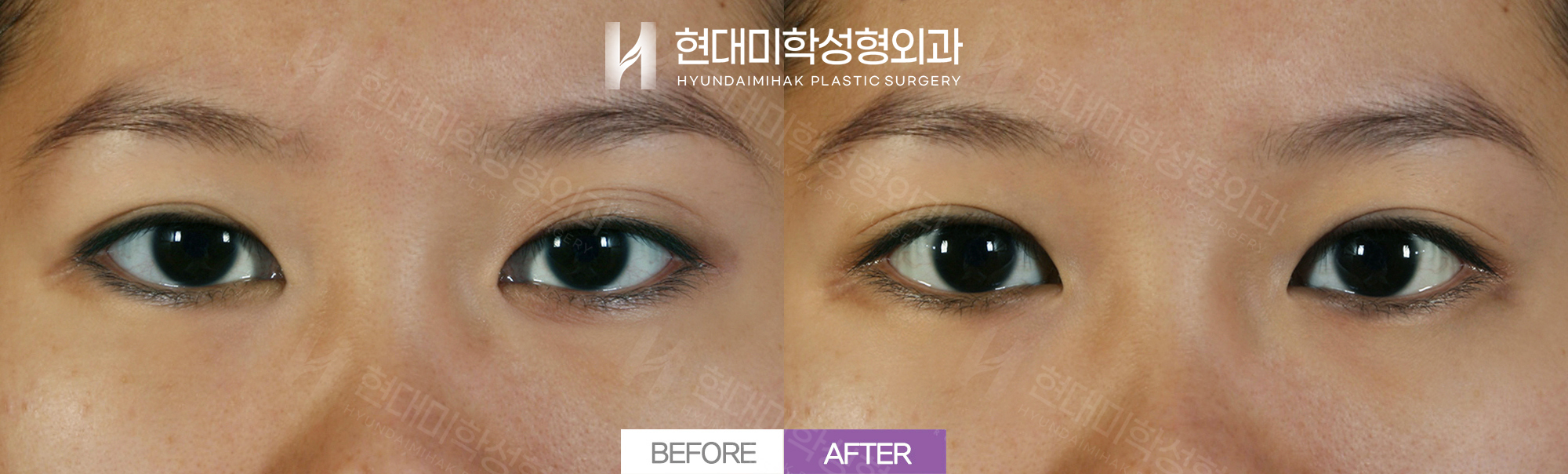 Natural Adhesion + Revision Double-Eyelid Surgery