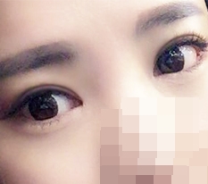 Eye incision + ptosis correction + front, back, lower canthoplasty