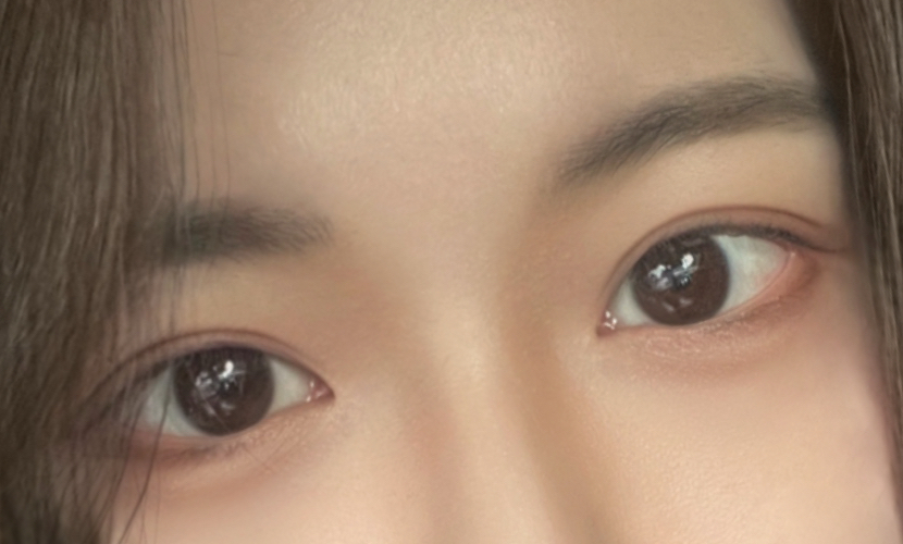 Kept the semi-out line and finished ptosis correction too
