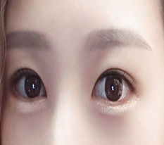 Natural adhesion + posterior/lower canthoplasty, 4 months in