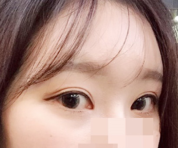 Eye Surgery Was Amazing>.<