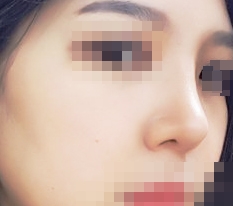 Nose surgery review~~!!