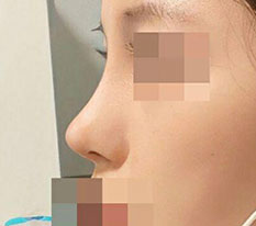 It's already been 8 months since my nose job haha