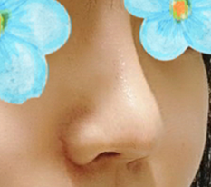 Totally satisfied with revision rhinoplasty☆