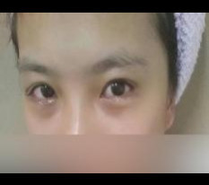 I love my double eyelids (incision) and dual canthoplasty so much :D