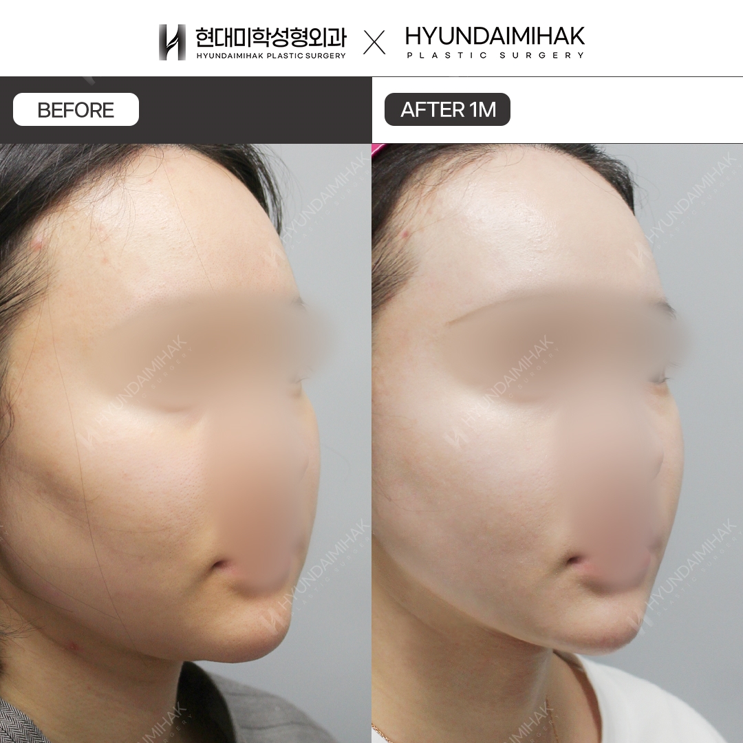 [Lifting] Double-Chin Thread Lift, 1 Month Post-Op