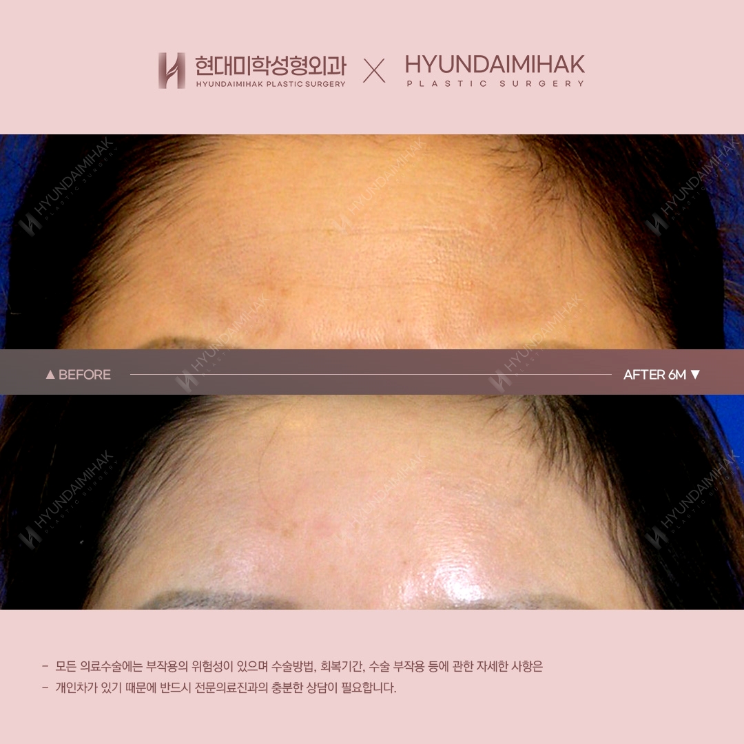 [Anti-Aging Surgery] Forehead Lift, 6 Months Post-Op