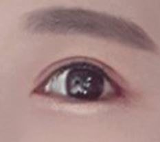Satisfied, satisfied eye surgery
