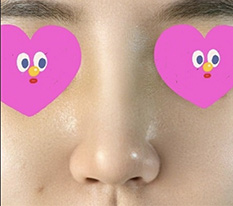 After revision rhinoplasty, I gained so much more confidence ^^