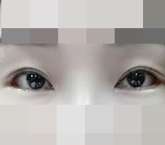 Review of outer + lower canthoplasty