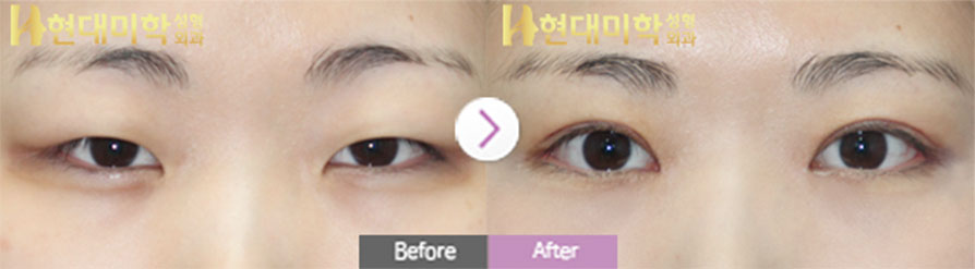 Incisional Eye Surgery, Ptosis Correction, Epicanthoplasty, Outer and Lower Canthoplasty