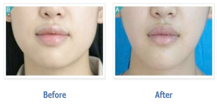 Square Jaw Surgery
