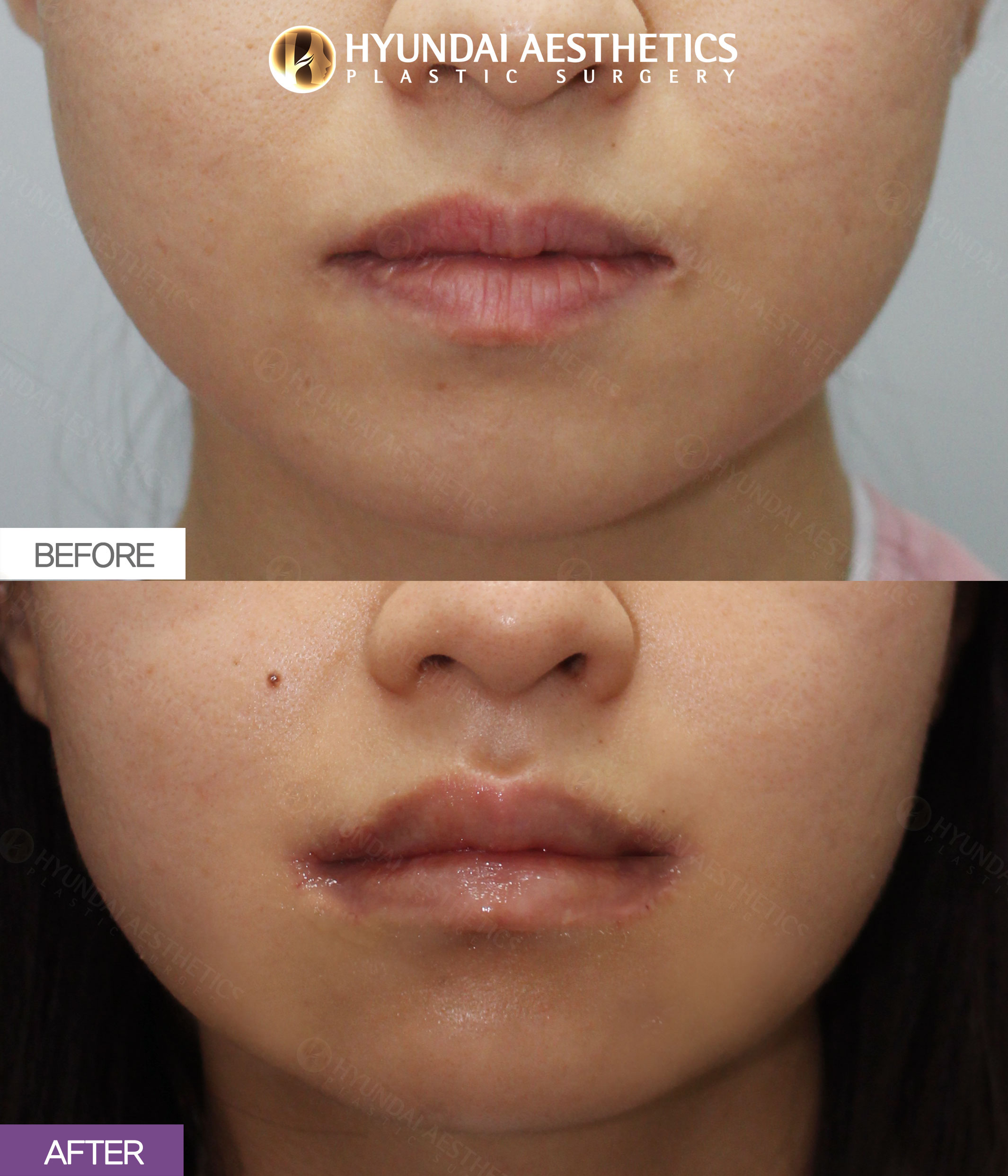 Lip Surgery, 1 Month