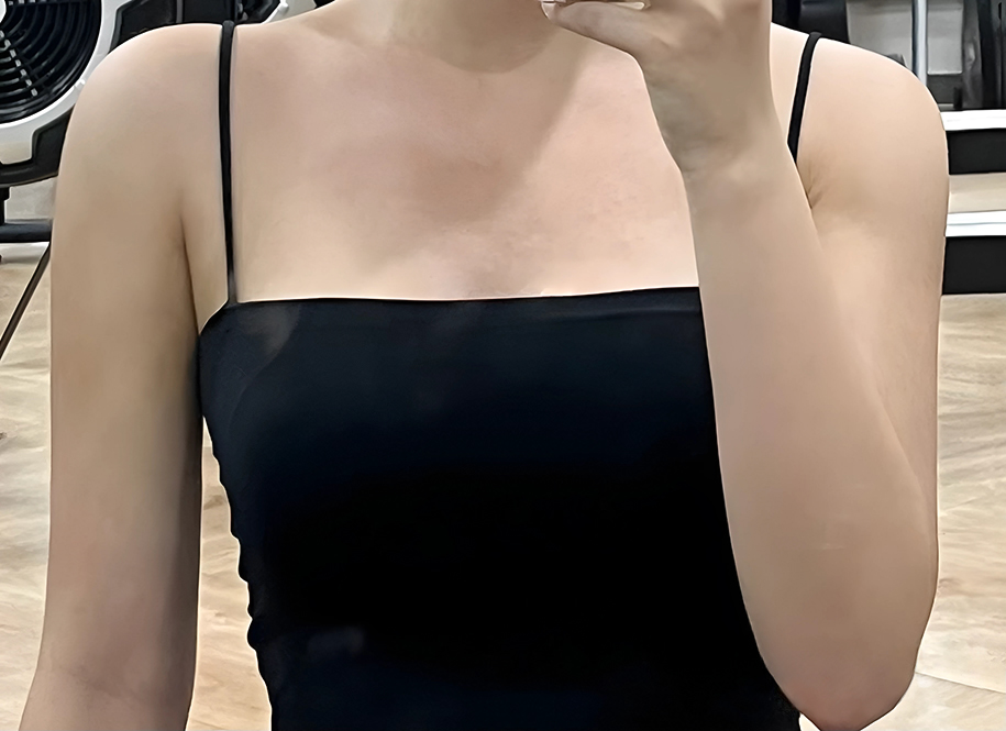 Successful skinny-arm liposuction💗 Arms/armpits/bra line/scapula/accessory breast