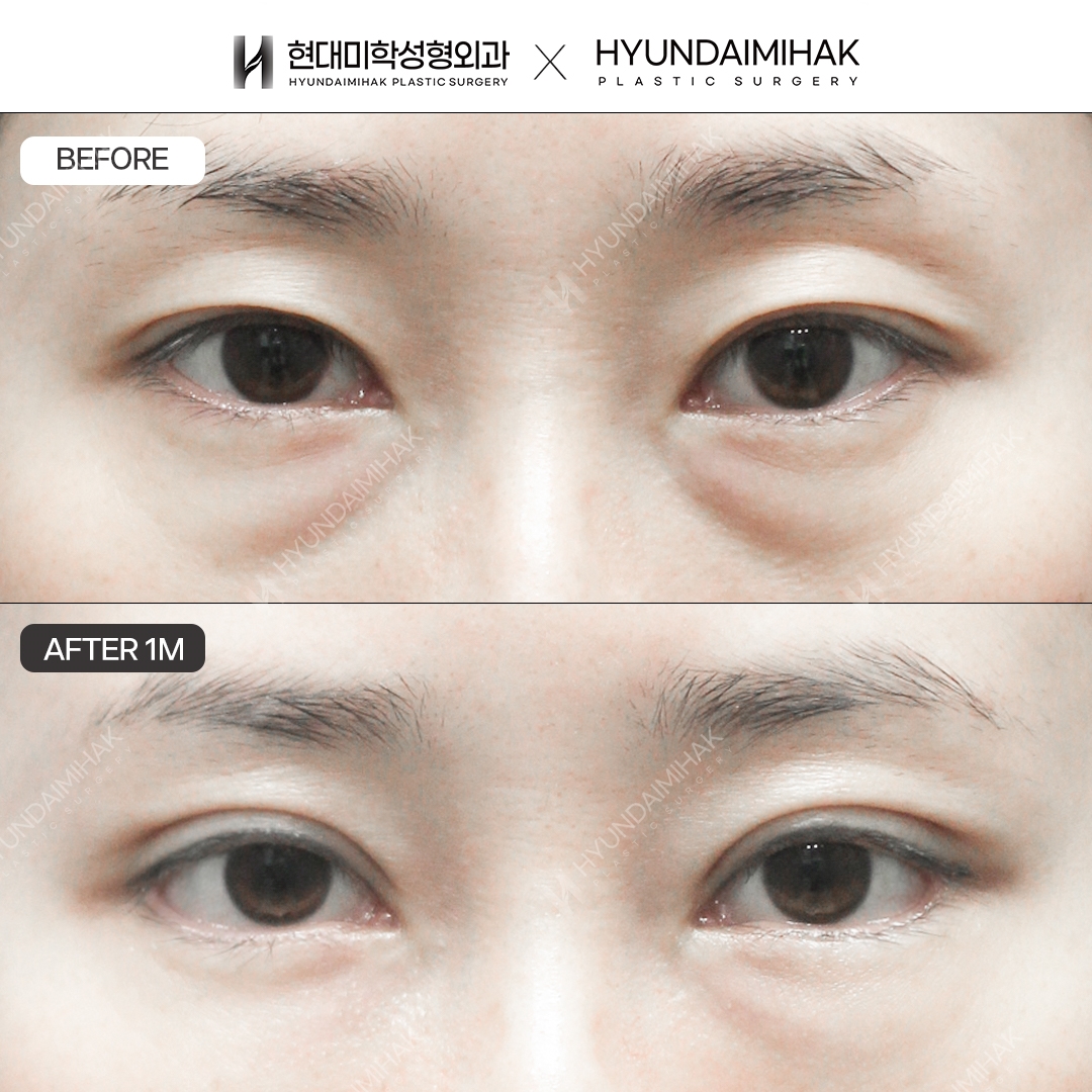 Natural adhesion double eyelids + under-eye fat repositioning + outer and lower canthoplasty