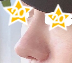 For men, it is the nose! I succeeded at Hyundai Aesthetic Surgery