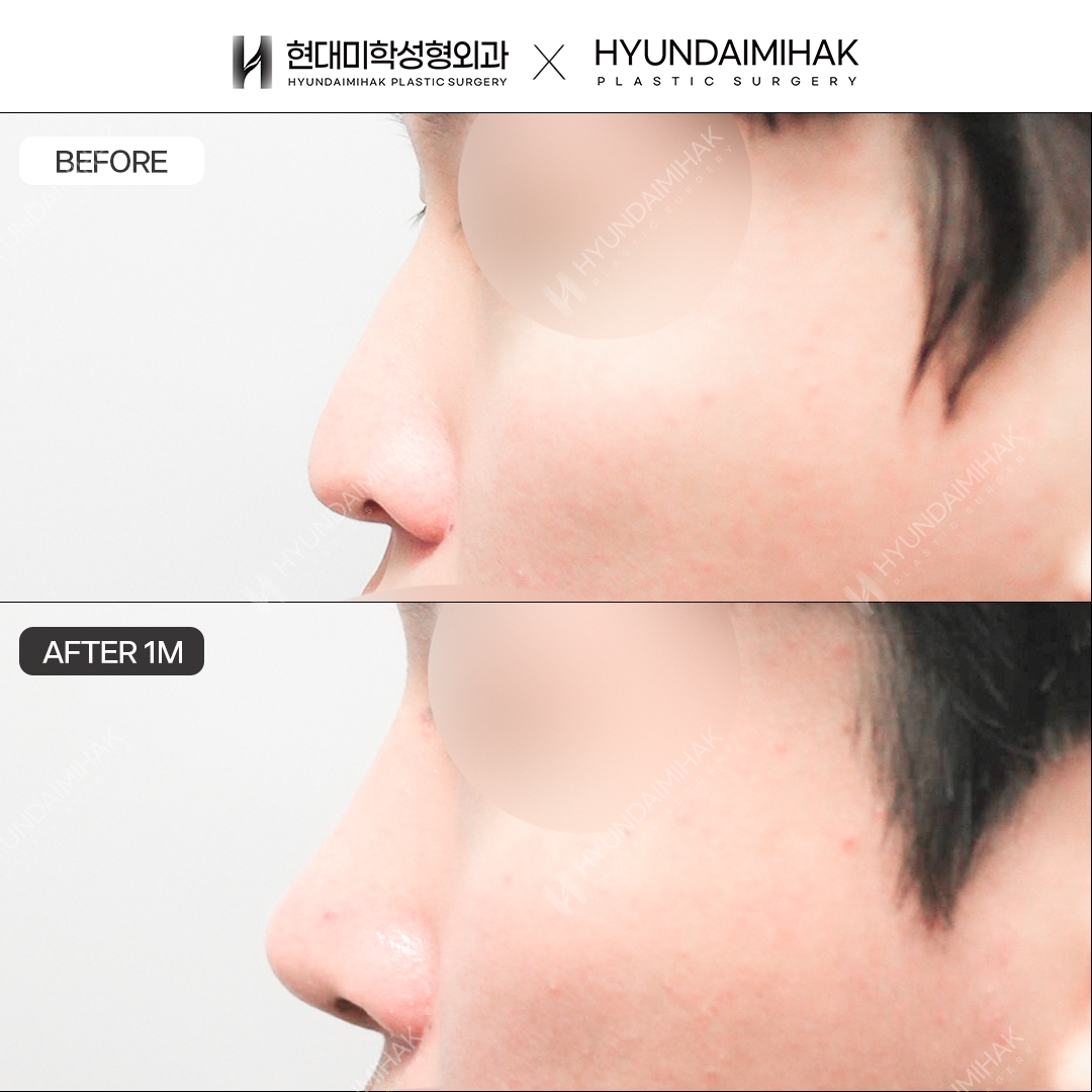 [Male Rhinoplasty] Bridge + Tip, 1 Month