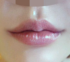 Everyone, get lip corner surgery instead of lip corner fillers