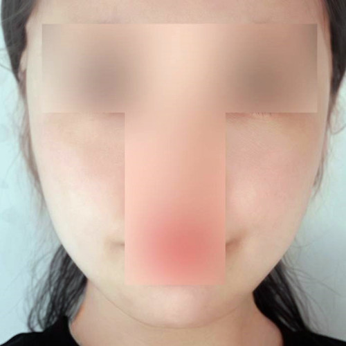 Thread lift for sagging under the chin and cheeks