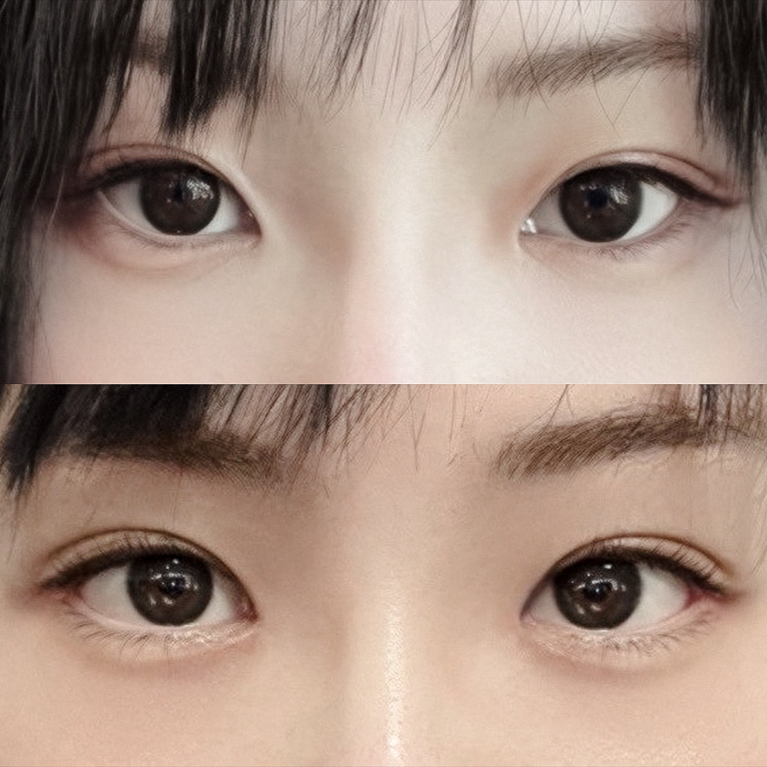 A go-to place for lower and outer canthoplasty ✨ 1 month after surgery at Hyundai Aesthetic Surgery