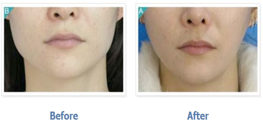 Square Jaw Surgery