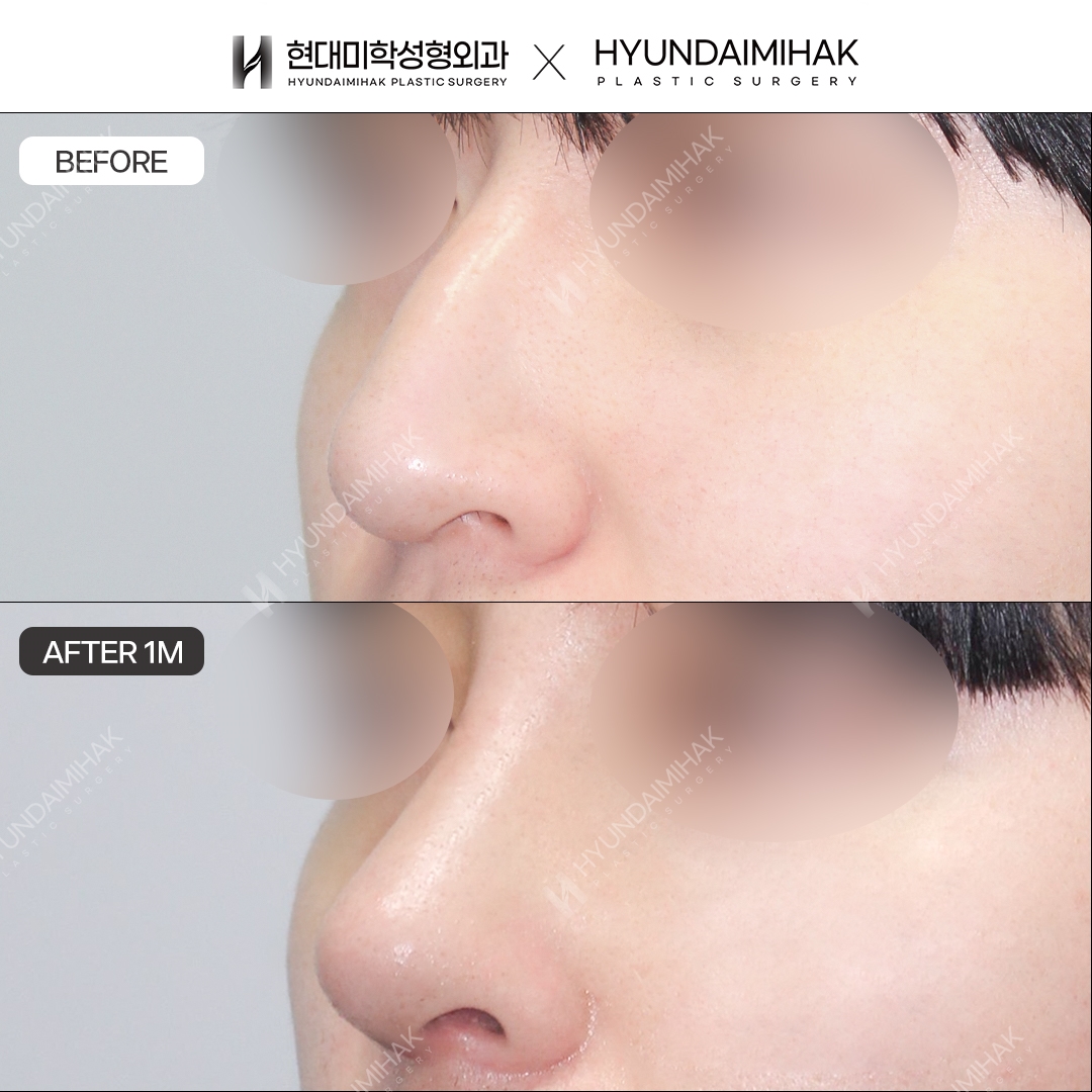 [Men's Rhinoplasty] Nasal bridge + nasal tip, 1 month post-op