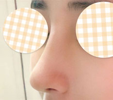 I'm glad I had the Hiko threads removed and got a nose job