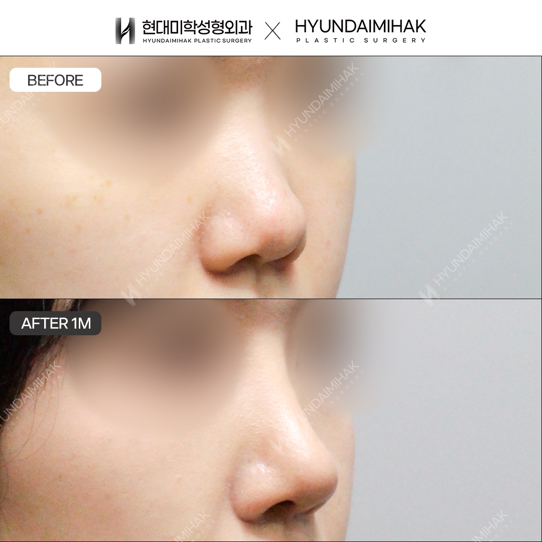 [Revision Rhinoplasty] Nasal bridge + nasal tip, 1 month post-op