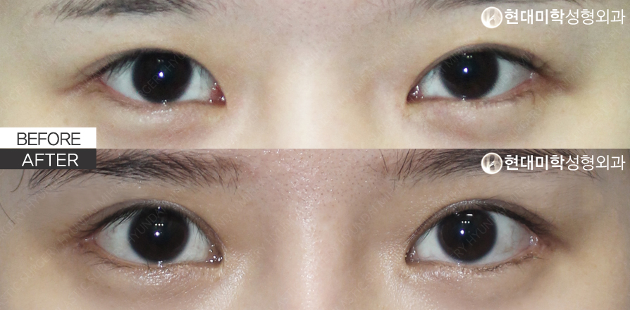 Incisional Ptosis Correction (Revision Surgery)