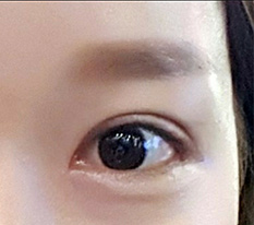 My story of successful double eyelids and canthoplasty at Hyundai Aesthetic Surgery~