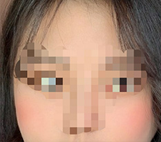 I got cheekbone revision surgery~ Thank you for doing it so beautifully^^