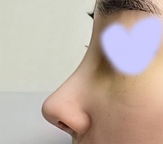 It's been 2 weeks since my nose revision surgery~~!