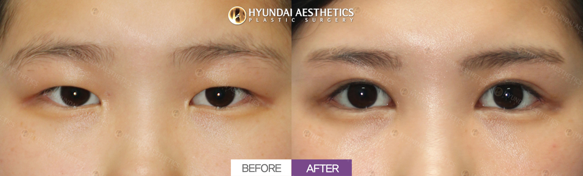 Incisional Double Eyelids + Upper-Eyelid Fat Removal + Inner-Corner Opening + Outer-Corner Opening + Lowering the Outer Corner, 1 Month