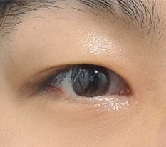 After a failed epicanthoplasty..
