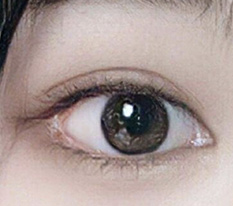 It's been 2 months since my dual canthoplasty — looks good, right??