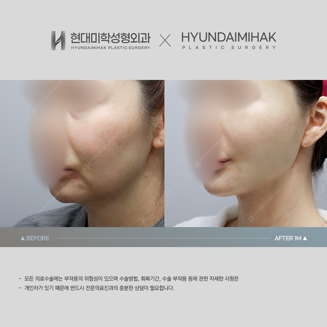 [Facial Rejuvenation] Thread Lift, 1 Month Later