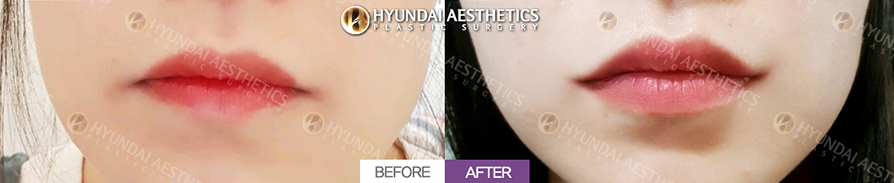 Mouth Corner Lift + Marionette Lines + Mouth Corner Botox