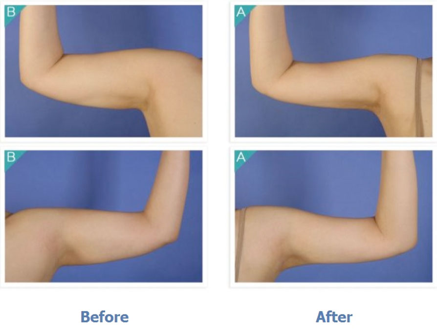 Body Contouring / Arm Liposuction