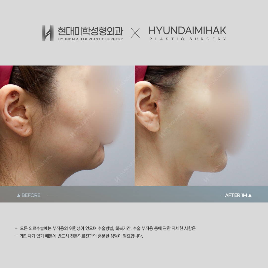 [Facial Rejuvenation] Thread Lift, 1 Month Later