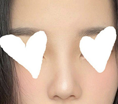 My bulbous nose correction turned out really well^,^