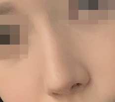 I had hooked-nose surgery, and they say I look more feminine and prettier'ㅜ'