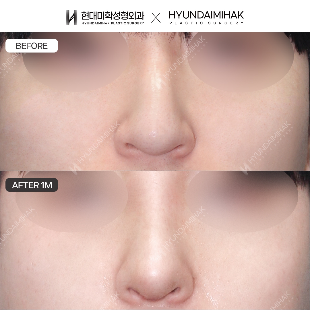 [Men's Rhinoplasty] Nasal bridge + nasal tip, 1 month post-op