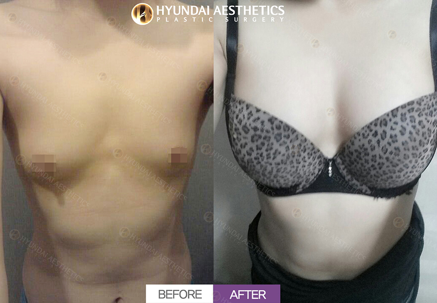 Breast Augmentation
