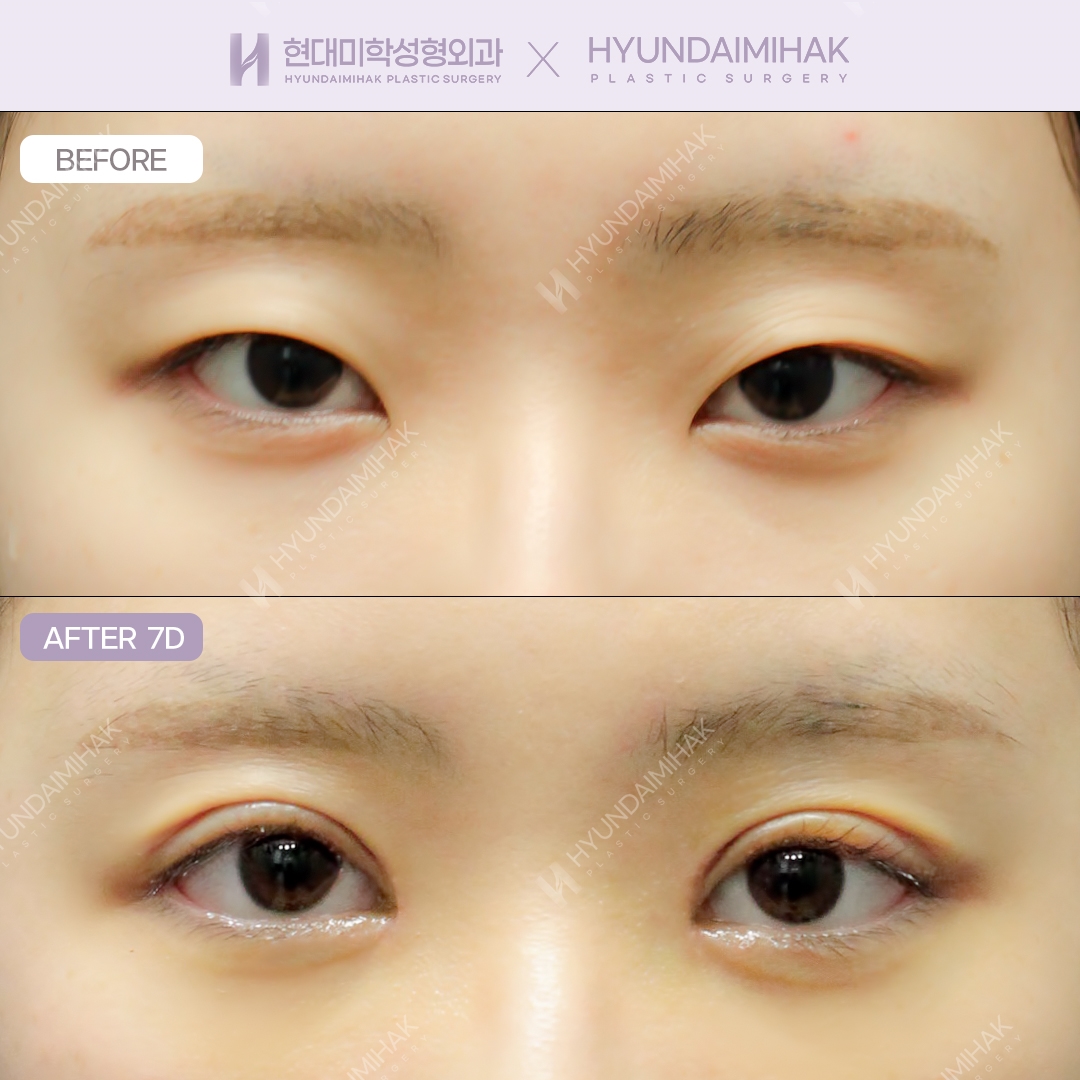 Incisional double eyelid surgery + dual canthoplasty
